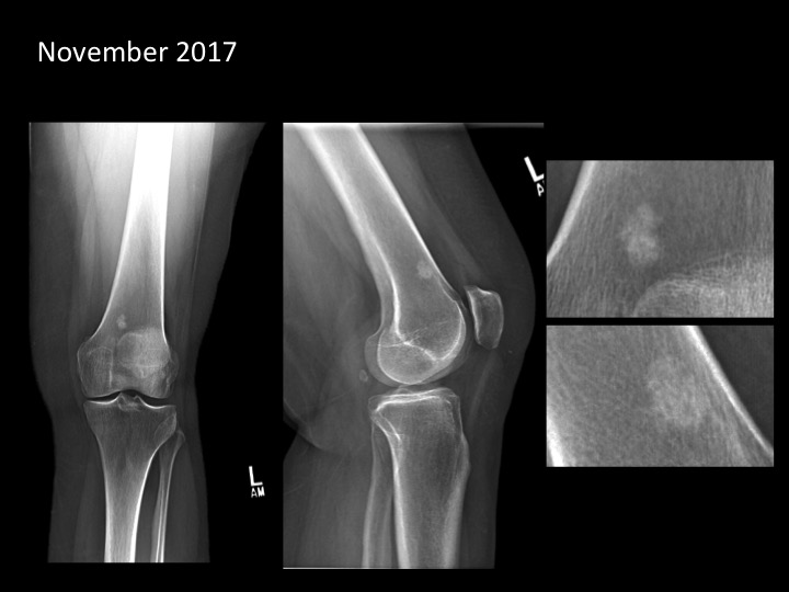 Figure 1 for case bone island ( RID4004 )